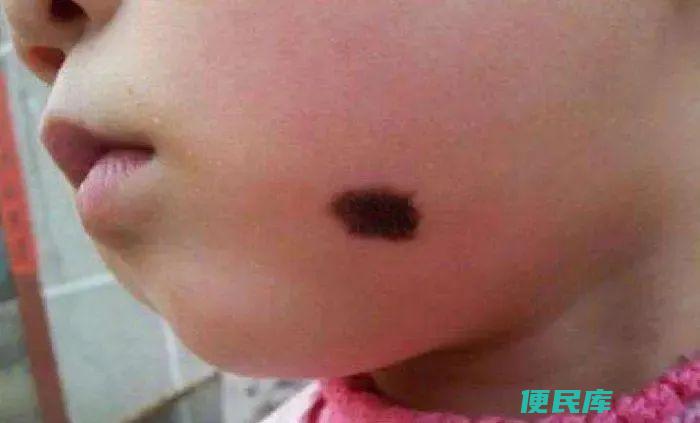 胎记是怎么形成的（为什么有的人生下来就会有胎记）