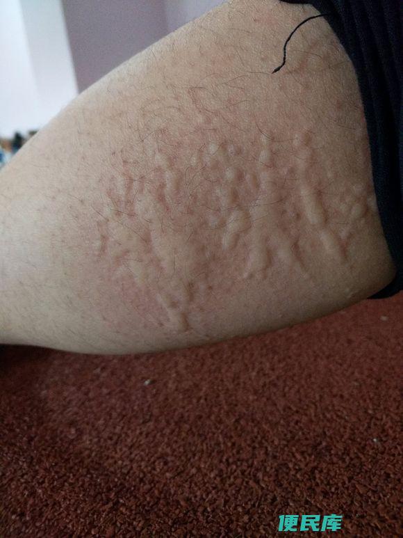 荨麻疹患者应禁忌食品（荨麻疹患者不能吃的食物推荐）
