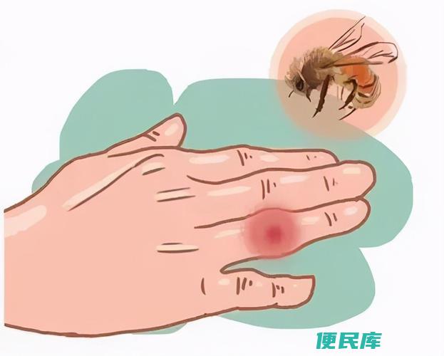 被蜜蜂蛰伤处理方法（应对被蜜蜂蛰伤的消肿之道）