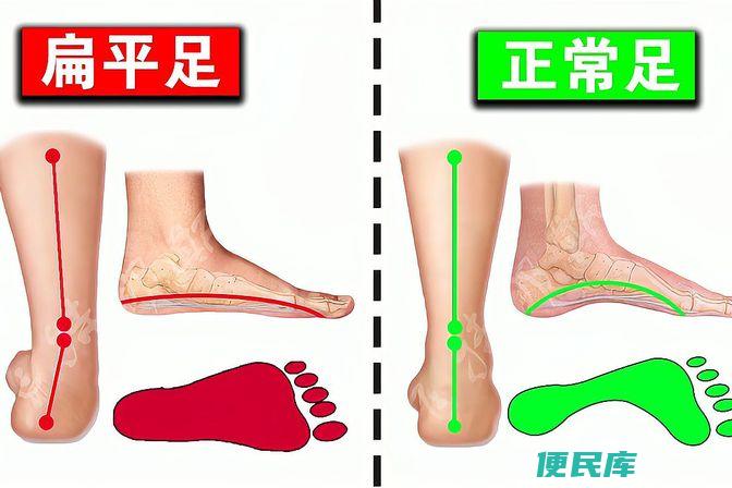 扁平足不适合入伍（解释为何扁平足不符合入伍条件）