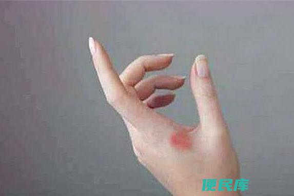 牙膏对烫伤是否有效（评估将牙膏涂抹在烫伤处的疗效）