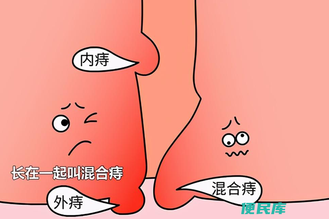 内痔和外痔的区别（内痔和外痔的症状和预防措施）