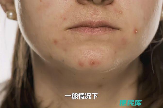 下颚长痘的原因解析（探讨下颚长痘痘的原因）