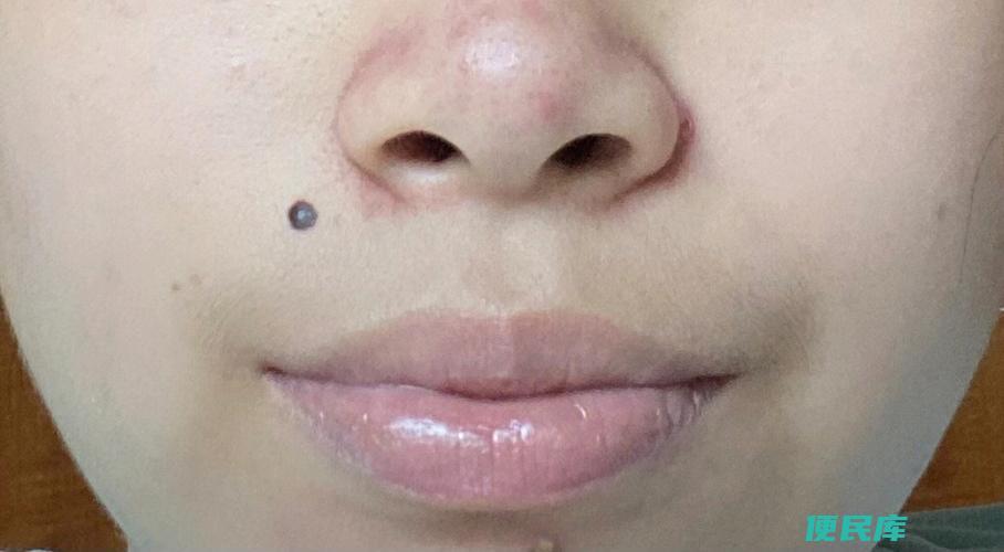 媒婆痣可消除吗（是否可通过点掉媒婆痣）