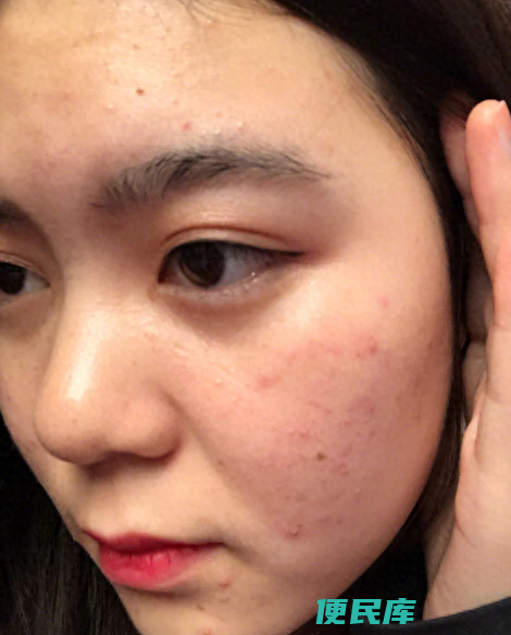闭口是怎么形成的（是什么原因促使脸上经常长闭口的）
