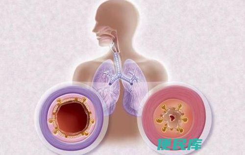 气管炎和支气管炎的区别（揭秘气管炎与支气管炎的区别）