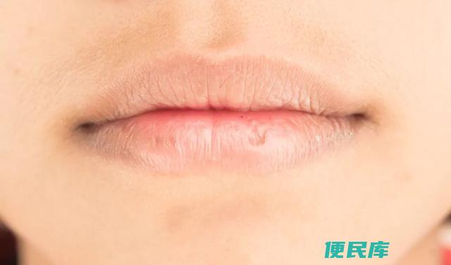 嘴角变白（去除嘴角发黑的有效方式）